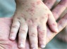 کودکان سیستانی و بلوچستانی بر علیه بیماری سرخک و سرخجه واکسینه می‌‎شوند